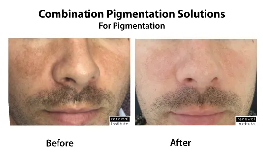 Vitamin C Brightening Serum – Dark Spot Corrector for Hyperpigmentation, Acne Scars & Uneven Skin Tone