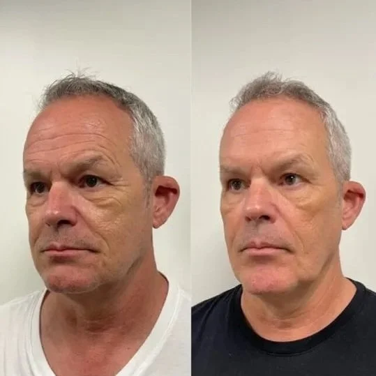 Vitamin C Brightening Serum – Dark Spot Corrector for Hyperpigmentation, Acne Scars & Uneven Skin Tone